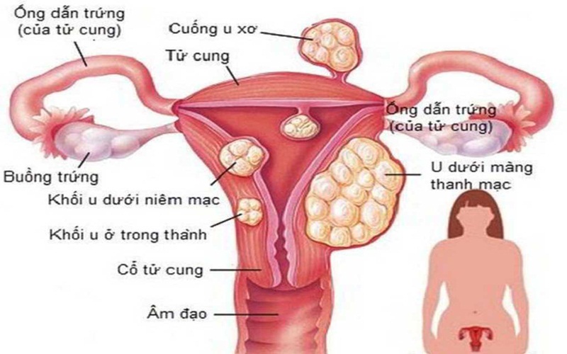U xơ tử cung có thể gây biến chứng nguy hiểm nếu không được điều trị kịp thời