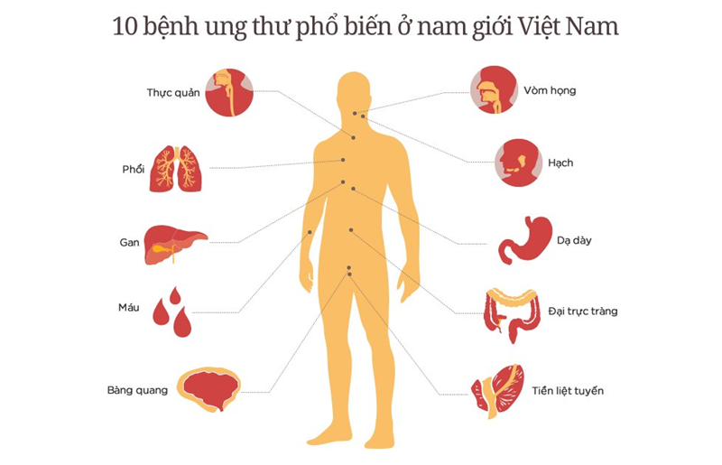 Ung thư vòm họng là 1 trong 10 bệnh ung thư phổ biến ở Việt Nam
