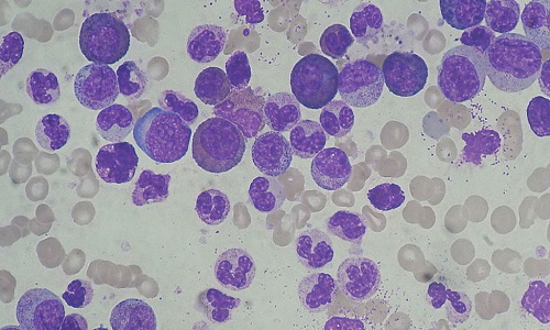 Lam máu Leucemia kinh dòng bạch cầu hạt