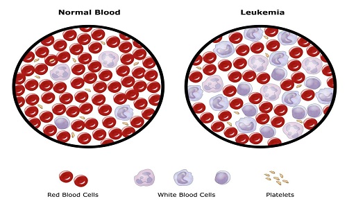 Lam máu bình thường và lam máu leucemia