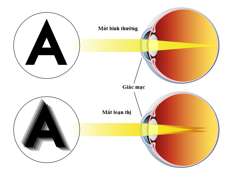 So với mắt bình thường, loạn thị là tật khúc xạ ở mắt khi nhìn vật có cảm giác mờ và méo mó hình ảnh.Loạn thị là tật khúc xạ ở mắt khi nhìn vật có cảm giác mờ và méo mó hình ảnh.