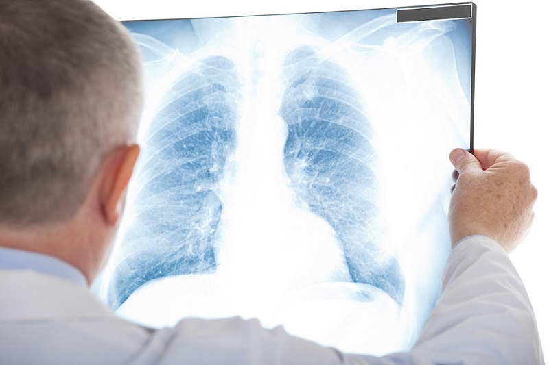 Chụp X-quang tim phổi thẳng nghiêng, phát hiện bệnh lý về phổi
