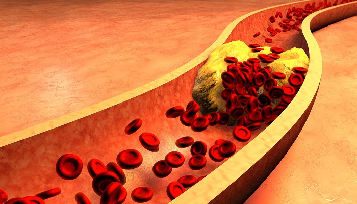 Rối loạn chuyển hóa lipid máu