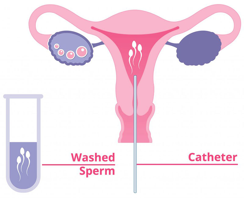 Mô tả quá trình bơm tinh trùng vào tử cung