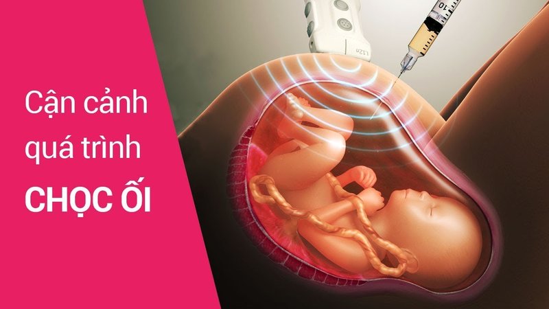 Chọc ối là phương pháp có độ chính cao trong chẩn đoán dị tật bẩm sinh ở trẻ và được thực hiện khi thai nhi 20 - 22 tuần tuổi