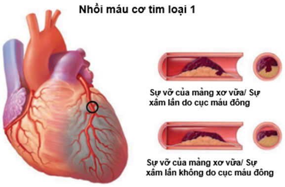 5 loại nhồi máu cơ tim theo chuyên gia MEDLATEC