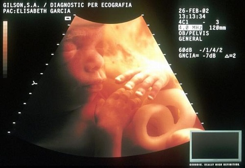  Siêu âm 3D cho phép nhìn thấy em bé ở nhiều góc độ