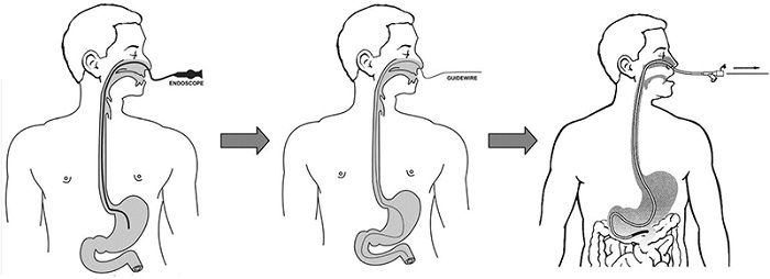 Hình minh họa phương pháp nội soi dạ dày qua đường mũi