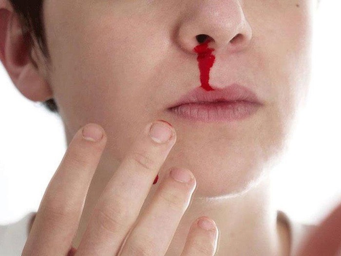 khi bạn bị chảy máu mũi nên đi nội soi tai mũi họng