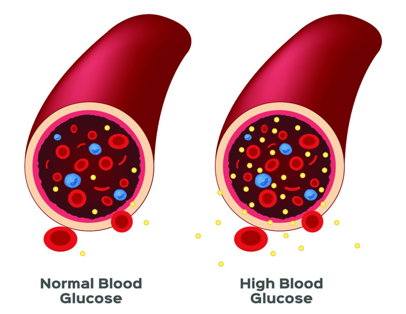Nồng độ Glucose trong máu có thể không chính xác bởi nhiều yếu tố