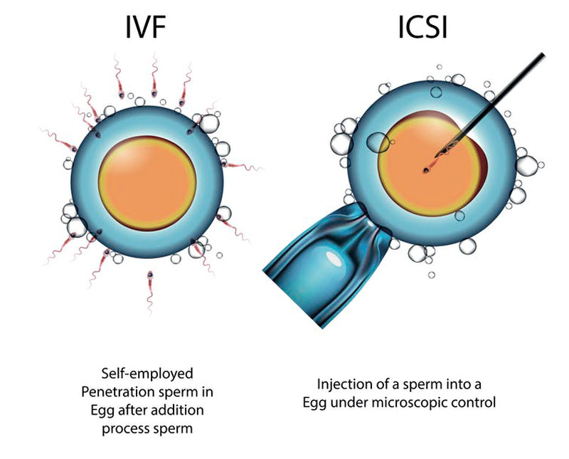 Phương pháp IVF và phương pháp ICSI