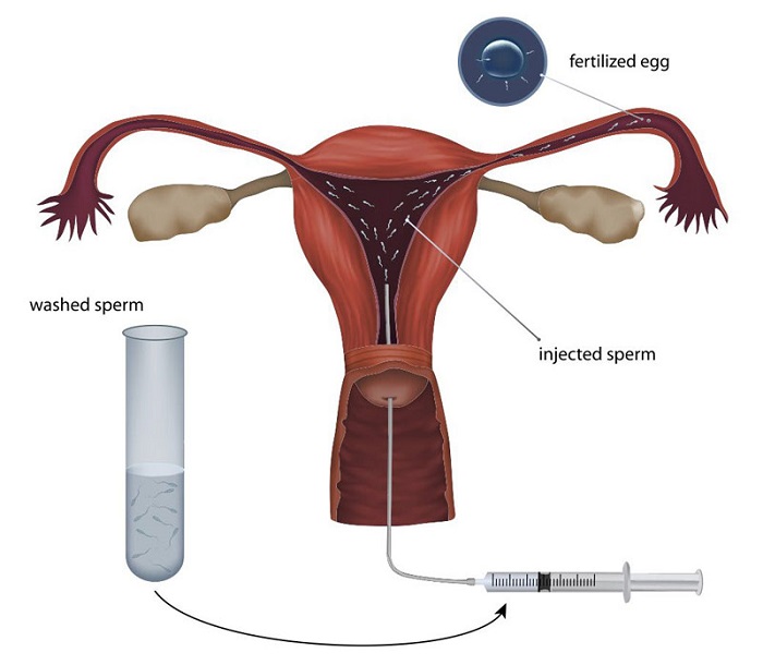 Quy trình thụ tinh nhân tạo gồm 3 bước: kích thích buồng trứng, chọn lọc tinh trùng và bơm vào tử cung
