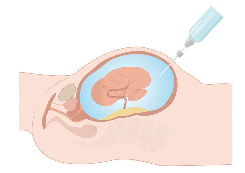 Xét nghiệm chọc ối là phương pháp chẩn đoán trước sinh thường dùng
