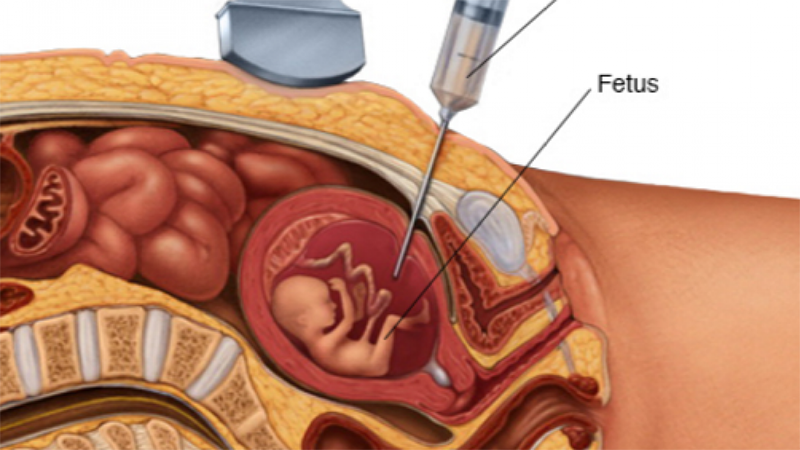 Chọc ối là phương pháp truyền thống lâu đời thông qua dịch ối để phát hiện dị tật thai nhi trước khi sinh