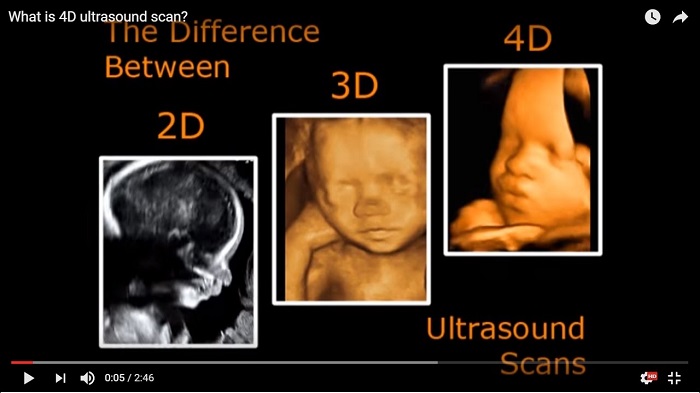 Siêu âm 3D khác siêu âm 4D ở việc ghi lại các chuyển động của con