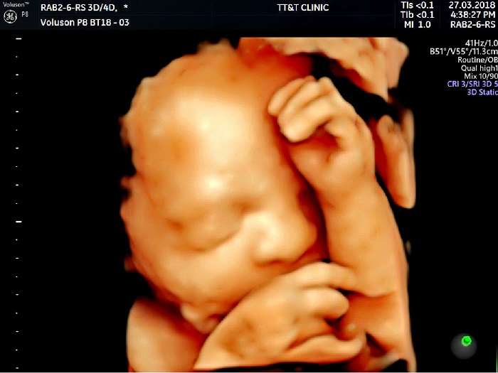Siêu âm 4D cho phép thai phụ trực tiếp quan sát hình ảnh của con cũng như các cử động của bé