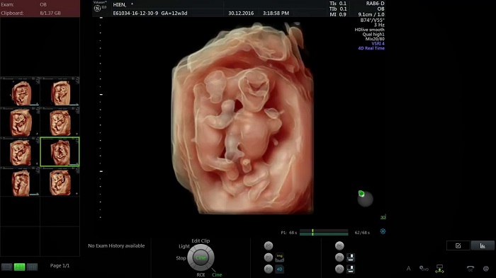 Siêu âm 4D cho phép mẹ quán sát chi tiết cấu trúc, các bộ phận của thai nhi