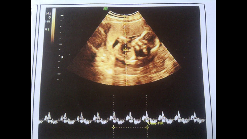 Nhịp tim của thai nhi ở tuần thứ 7