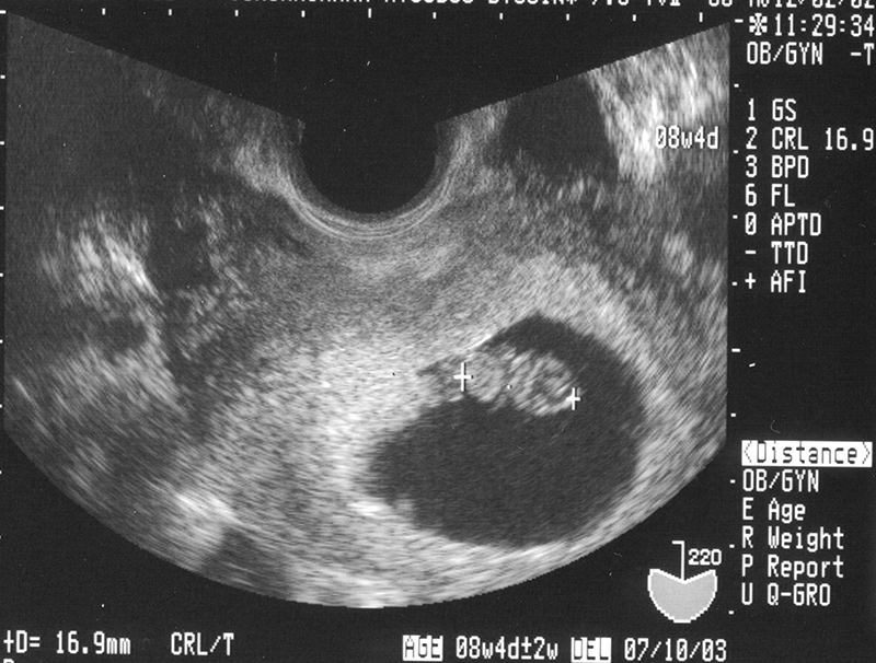 Hình ảnh siêu âm 2D của 1 em bé 8 tuần tuổi