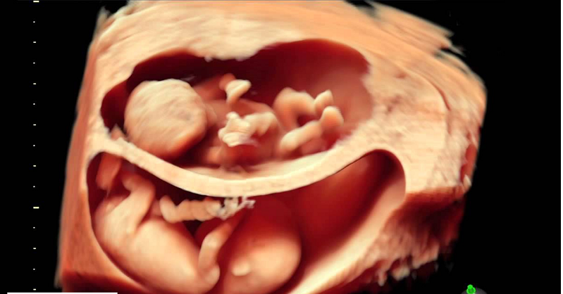 Trường hợp mang thai đôi đa thai sẽ được chỉ định siêu âm Doppler thai