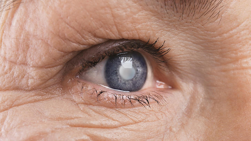Hình ảnh bệnh nhân bị đục thủy tinh thể ở mắt