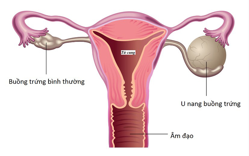 U nang buồng trứng là bệnh thường gặp ở phụ nữ