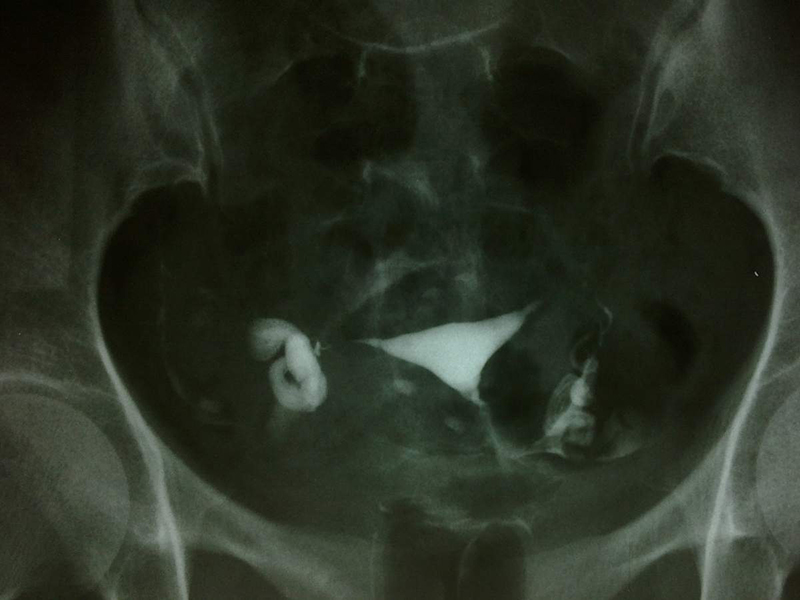 Bên cạnh siêu âm nang buồng trứng thì chụp X-quang cũng có thể chẩn đoán căn bệnh này