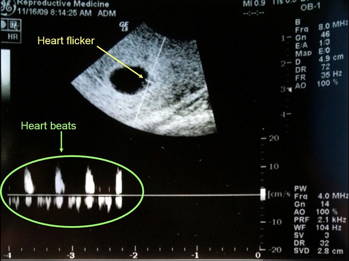 Hình ảnh nhịp tim thai những tuần đầu của thai kỳ