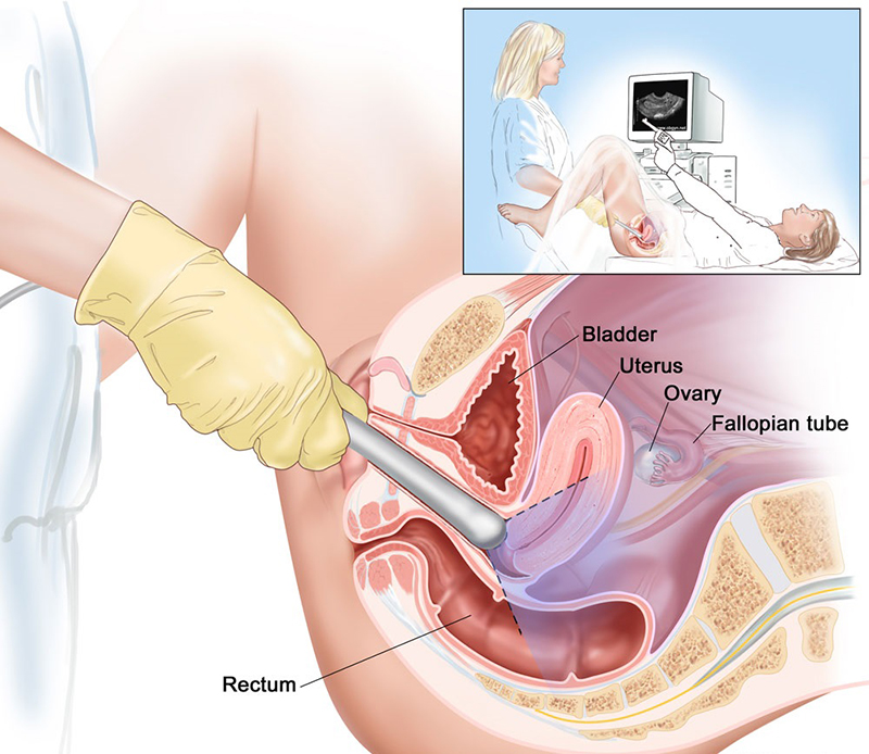 Siêu âm phần tử cung giúp phát hiện các bất thường, dị tật tại cơ quan này