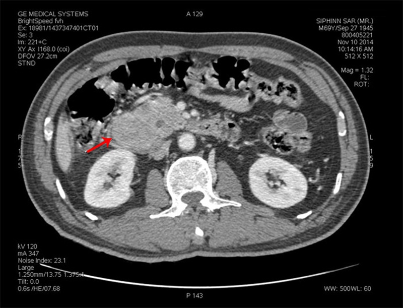 Hình ảnh chụp CT bệnh nhân viêm tụy cấp sau khi đã siêu âm chẩn đoán