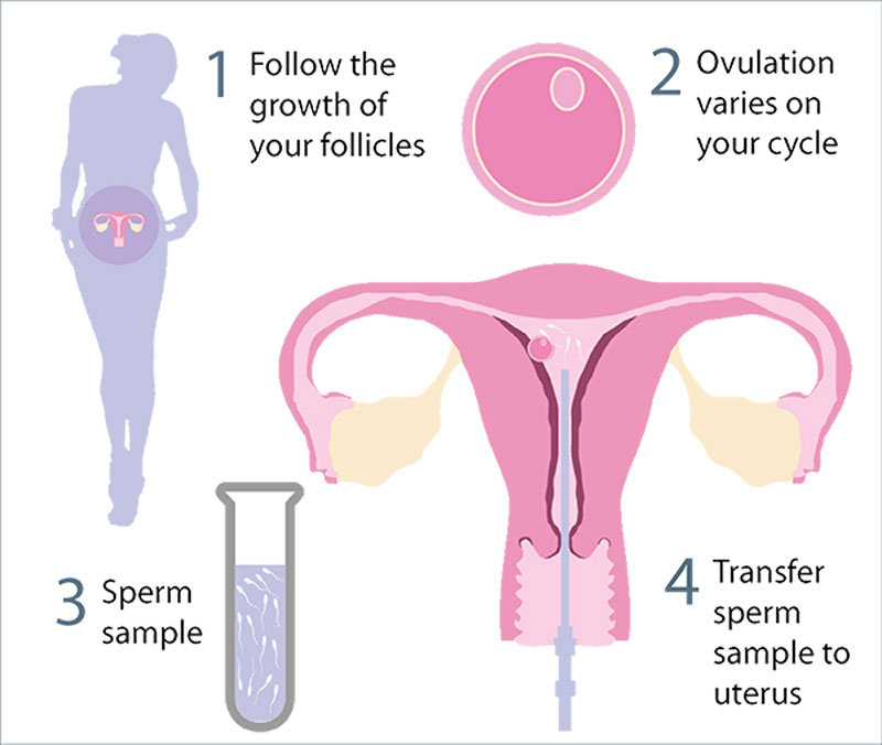 Sơ lược về quá trình bơm tinh trùng