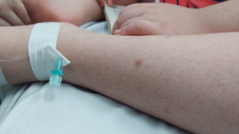Cha mẹ vô cùng lo lắng khi nhà có con nhập viện điều trị sốt xuất xuất huyết