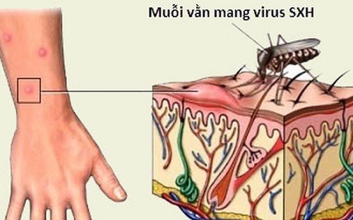 muỗi vằn mang virus sốt xuất huyết