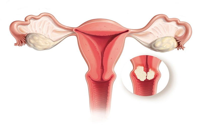 Ung thư cổ tử cung thuộc nhóm bệnh ung thư có khả năng gây tử vong cao ở phụ nữ