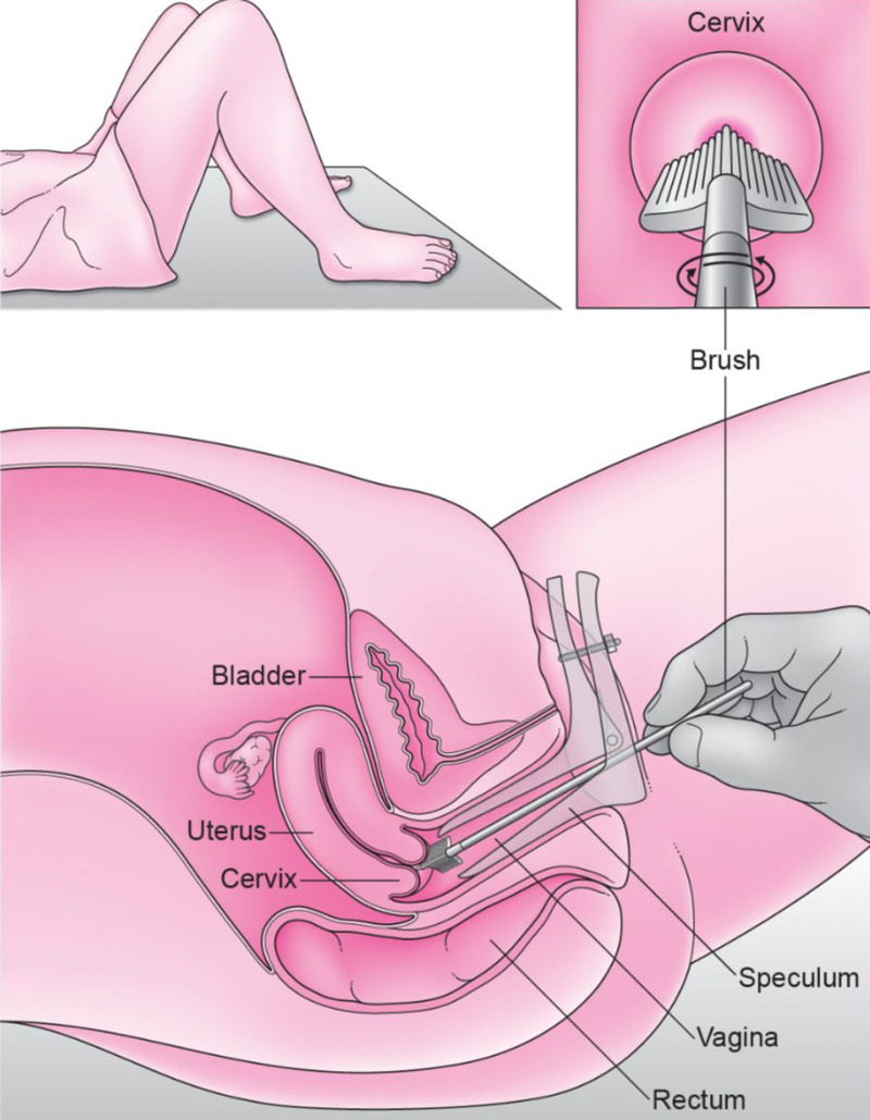 Phương pháp sàng lọc tế bào Pap smear
