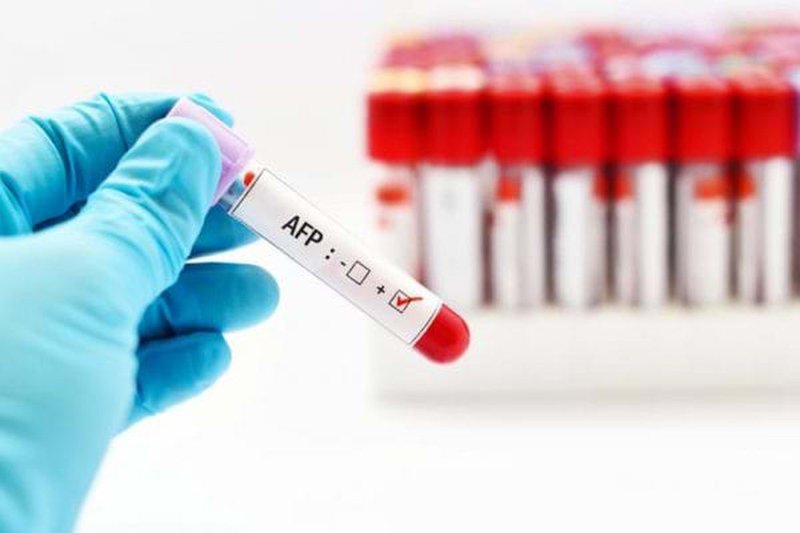 Xét nghiệm máu tìm dấu ấn ung thư gan AFP