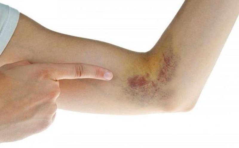 Thường xuất hiện các vết bầm tím trên da có thể là dấu hiệu của ung thư máu