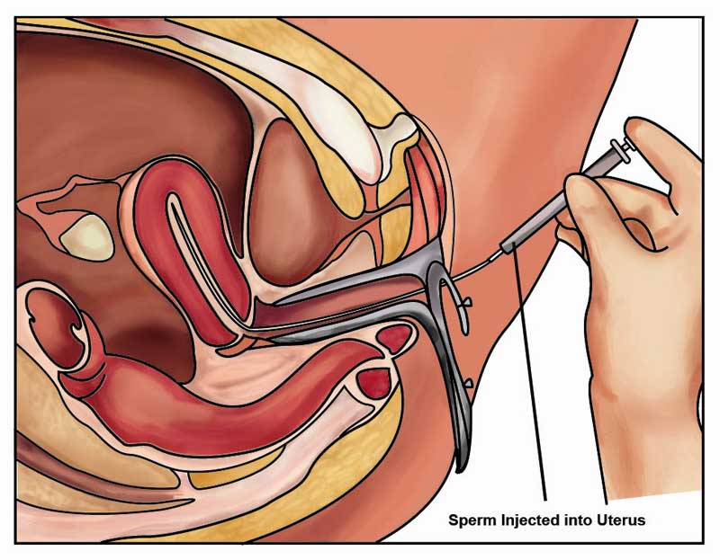Thực hiện kỹ thuật bơm tinh trùng vào cổ tử cung có đau không