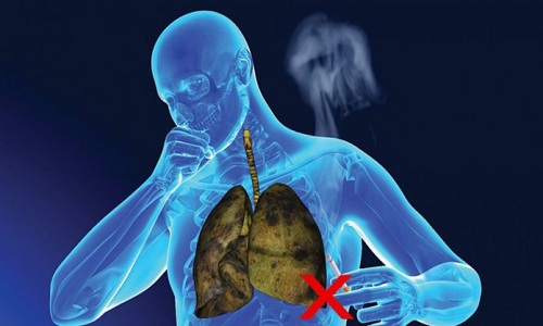 Hút thuốc lá - nguyên nhân hàng đầu gây ung thư phổi