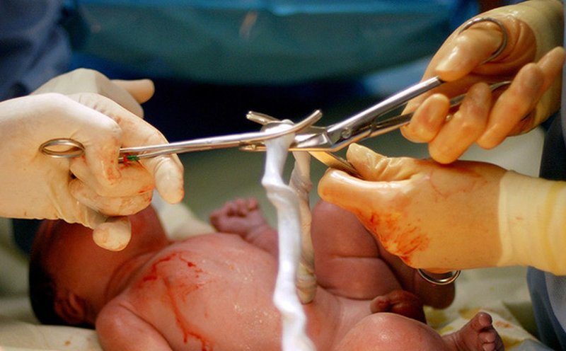 Trẻ sơ sinh có nguy cơ mắc phải uốn ván trong quá trình cắt dây rốn