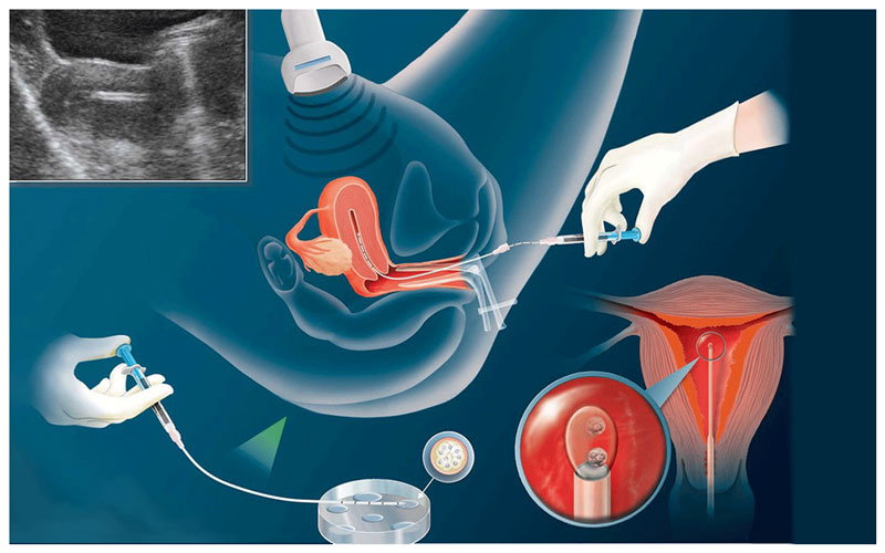 Tìm hiểu về phương pháp bơm tinh trùng vào tử cung
