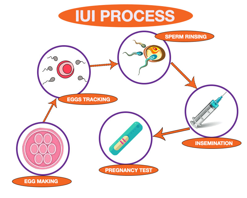 Phương pháp IUI giúp tăng khả năng thụ thai.