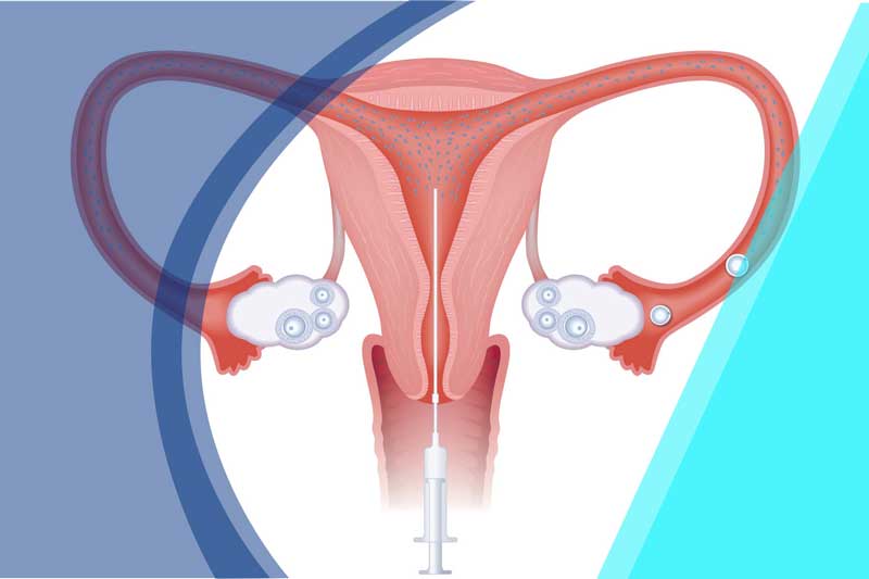 Tử cung của người vợ vẫn hoạt động bình thường thì mới áp dụng kỹ thuật bơm tinh trùng vào tử cung 