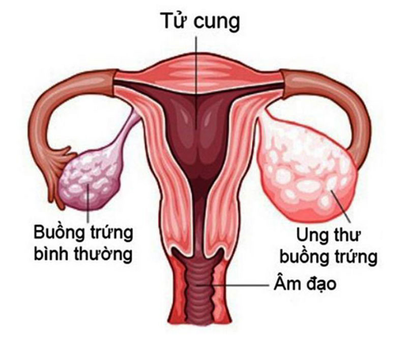 Ung thư buồng trứng là bệnh nguy hiểm với phụ nữ
