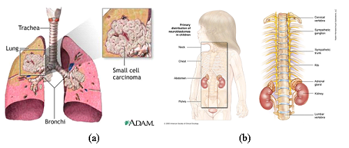 Ung thư phổi thế bào nhỏ và u nguyên bào thần kinh