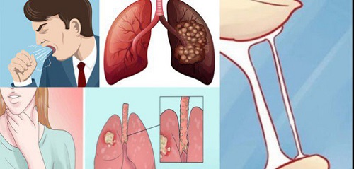 ung thư phổi cần được phát hiện và điều trị sớm