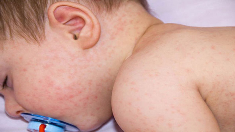 Phát ban sau 5 ngày kể từ lúc tiêm vắc xin là biểu hiện thường gặp ở trẻ nhỏ