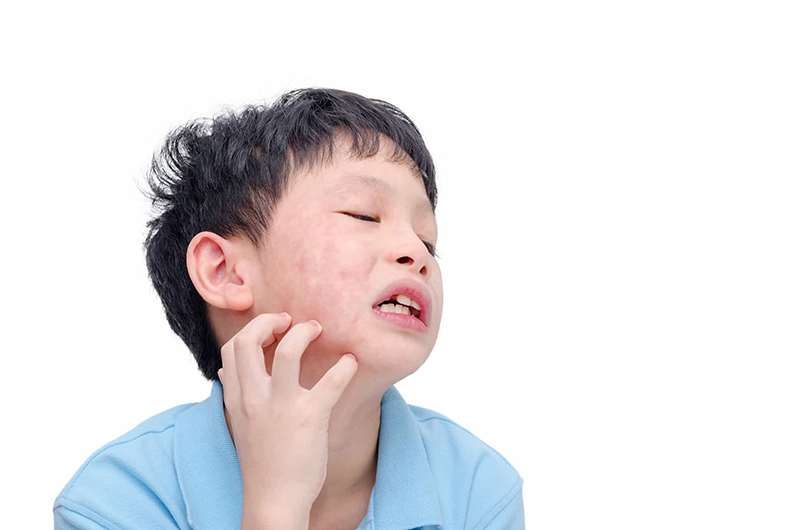 Bệnh quai bị rất dễ gặp ở trẻ nhỏ, đặc biệt là trẻ trong giai đoạn 5 - 9 tuổi