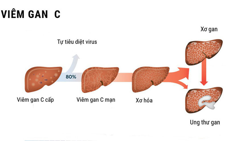 Viêm gan C có thể dẫn tới <a href='https://medlatec.vn/tin-tuc/top-8-dau-hieu-ung-thu-gan-khong-phai-ai-cung-nhan-ra-s91-n20290'  title ='ung thư gan'>ung thư gan</a>