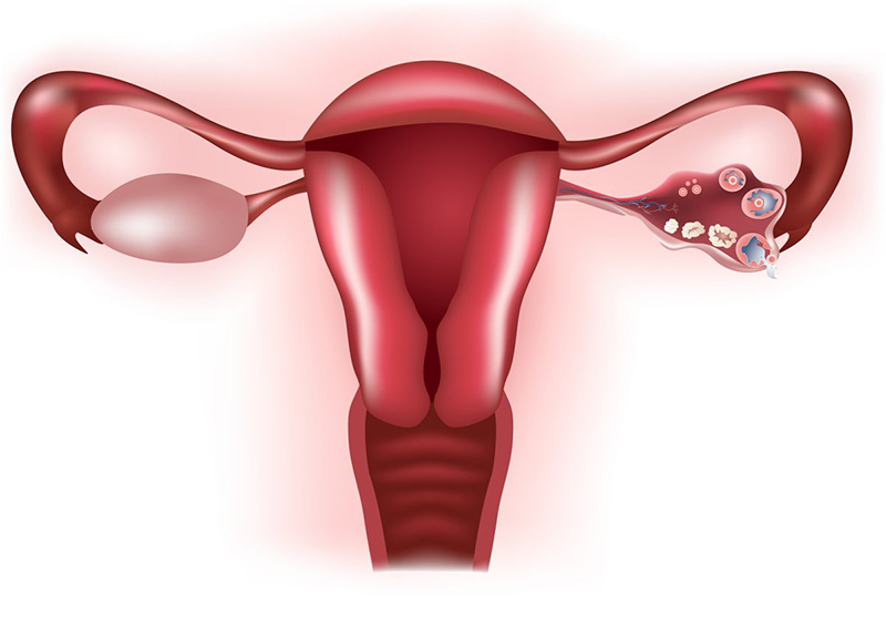 Mắc các bệnh lý liên quan đến buồng trứng khiến khả năng thụ thai ở nữ giới là rất khó xảy ra